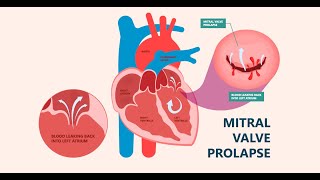 Mitral valve Prolapse  Definition Types Causes Symptoms Diagnosis Treatment [upl. by Colwen]