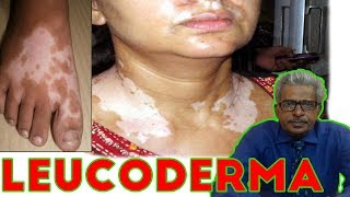 Leucoderma Treatment in Homeopathy by Dr PS Tiwari [upl. by Nawrocki653]