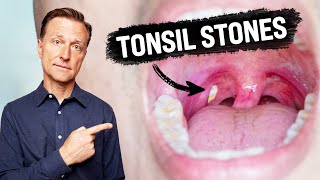 5 Best Waterpiks for Tonsil Stones — Take a Good Care of Your Health [upl. by Irneh]