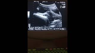 ultrasound breech 20 week baby boy [upl. by Noffets790]