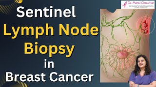 What is Sentinel Lymph Node BiopsySLNB in Breast Cancer  Dr Mansi Chowhan breastcancer cancer [upl. by Yrak]