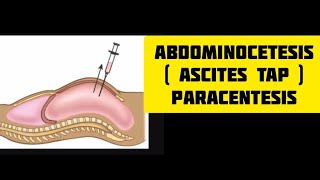 Ascites tap procedure  paracentesis  abdominocetesisn medics skills shorts [upl. by Orms424]