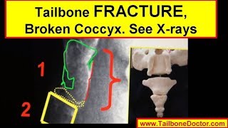 Xrays showing COCCYX FRACTURE broken tailbone [upl. by Andriana]