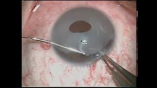 Eye Color Change New iris Implant removal exhanged to Brightocular [upl. by Ezarras]