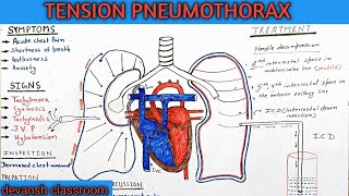 tension pneumothorax in Hindi [upl. by Eliza]