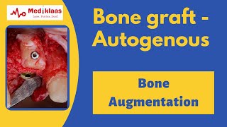 Autogenous Bone Grafts [upl. by Annahsohs]