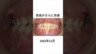 反対咬合の子供の矯正治療 矯正歯科 dentist 歯列矯正 [upl. by Limann]