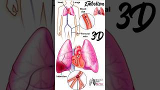 Embolism medical animation 3d short  BiologywithAliya [upl. by Nay]