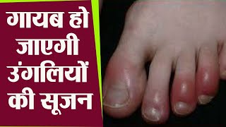 सर्दियों में उँगलियाँ सूजने का Homeopathic इलाज  Chilblains  Swollen hands amp fingers in Winter [upl. by Dittman]