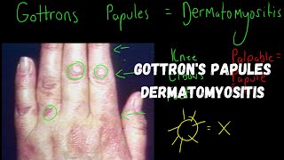 Gottrons Papules  Dermatomyositis [upl. by Isa]