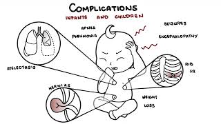 What is Pertussis and whooping cough  Bordetella pertussis symptoms pathophysiology and treatment [upl. by Enylhsa]