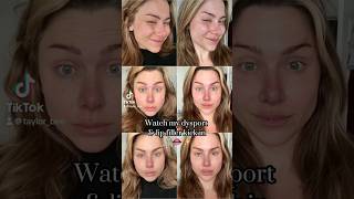 Watch my lip filler amp Dysport set in  daily progress [upl. by Yenoh289]