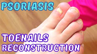 Psoriasis Toenails reconstruction [upl. by Aliahs]