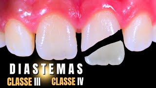 Restaurações Anteriores CIII IV Fechamento de Diastemas e Reanatomização de Dente Conoide [upl. by Yleme98]