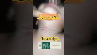 IntertrigoFungal infection of skin folds Pediatrics dermatology [upl. by Alyss]