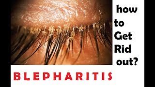 what is blepharitis How to get rid out of this hindi [upl. by Christin]