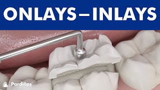 Dental inlays and onlays © [upl. by Pavyer20]