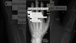 Delayed puberty in boys [upl. by Charlton]