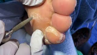 June clinic toenails calluses and corns continue [upl. by Ras]