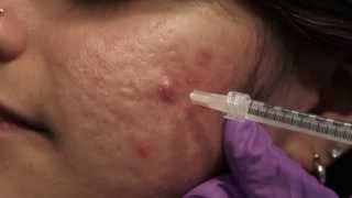 Watch amp Learn Intralesional injections [upl. by Blatman]