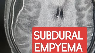 Subdural empyema MRI NCCT  HRCT radiology case interesting brain infection anatomy [upl. by Nihhi]