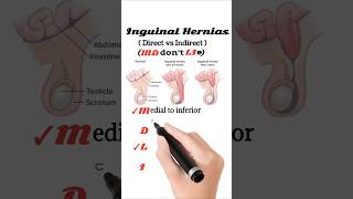 Direct vs Indirect inguinal hernia [upl. by Bedell617]