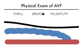 Hemodialysis Access 101 03  Physical Exam of AVF [upl. by Linsk]