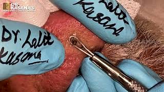 70 YEAR OLD NOSE BLACKHEADS REMOVAL AT DRKASANAS CLINIC [upl. by Okorih]