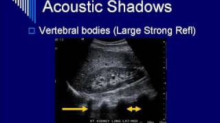 Physics of Ultrasound Image Artifacts Segment 5 [upl. by Atekihc]