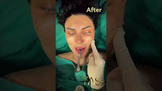 Revolutionary Scarless Facelift Transformation by Dr Suleyman Tas [upl. by Ahsirat]