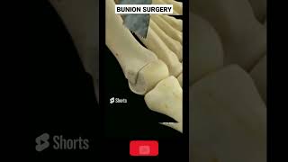 BUNION bunion treatment buniontoe bunion [upl. by Imotas547]