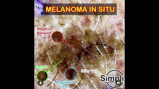 Melanoma in situ Dermoscopy [upl. by Oswell]