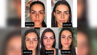 Tratamento para o Melasma com os Óleos Essenciais doTERRA com Stefane Souza Makeup [upl. by Estas]