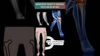 Mnemonic to Learn Pagets disease of Bone🦴pathology bone orthopedics mbbs doctor l [upl. by Aicilif]