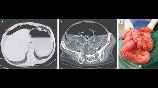 Pneumatosis intestinales mit Pneumoperitoneum [upl. by Koziarz85]