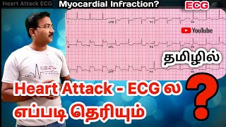 Heart attack ECG in tamil  MI myocardial infarction  anterior Inferior amp lateral wall MI ps tamil [upl. by Winifield]