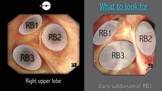 Mastering Bronchoscopy for Thoracic Surgery Chapter 2 [upl. by Wanda]