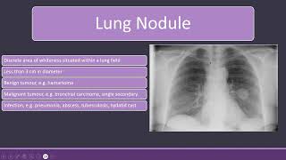 Chest Xray with Lung Nodules and Bronchiectasis radiology [upl. by Haggerty833]