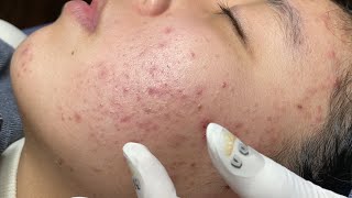 ACNE TREATMENT VU QUYNH MI  Blackheads Of Tweens 2024 EX [upl. by Haodnanehs]