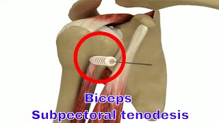 Biceps Subpectoral Tenodesis Effective Surgery for Shoulder Pain Relief and Muscle Strength [upl. by Anemaj]