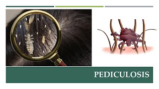 Live Head Louse  Pediculus humanus capitis [upl. by Jamesy]