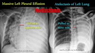 pleural effusion vs atelectasis [upl. by Winer]