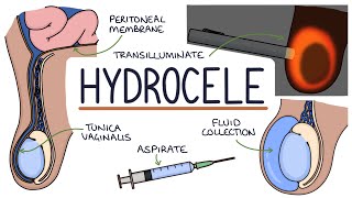 Understanding Hydroceles [upl. by Adnovaj519]