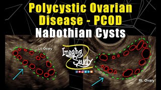 Polycystic Ovarian Disease with Nabothian Cysts  PCOD  Ultrasound  TVS  Case 256 [upl. by Sander]