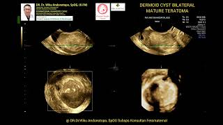 Dermoid Cyst Mature Teratoma [upl. by Ricca]