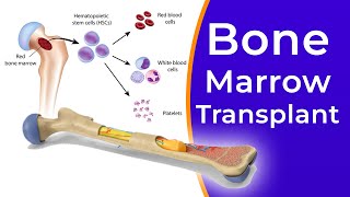 Allogeneic stem cell transplants at Siteman Cancer Center [upl. by Fuhrman196]