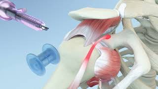 Right Shoulder Rotator Cuff Repair and Biceps Tenodesis Animation [upl. by Valeria148]