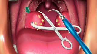 Animation Surgery of Tonsillectomy amp Adenoids [upl. by Atirat]