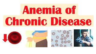 Anemia of Chronic Disease  Causes Pathophysiology Signs amp Symptoms Diagnosis Treatment [upl. by Nylirad]