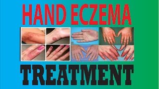 DyshidrosisDyshidrotic eczemaHand eczemaPompholyx treatment [upl. by Aspia]